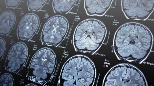 Epilepsy newsletter